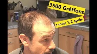 Ma tète 3 mois et demis après ma greffe