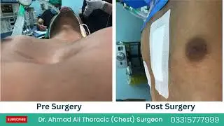 Transforming Lives with Pectus Excavatum Surgery | Chest Wall Deformity Treatment | Patient Review