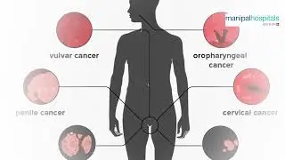 HPV vaccine | Dr. Rahul Chauhan | Cervical Cancer Vaccine | Manipal Hospital Ghaziabad