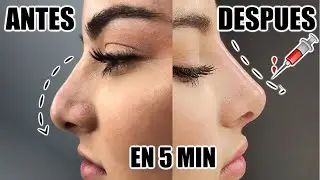 ME INYECTE ACIDO HIALURONICO! La rinomodelacion tiene efectos secundarios?