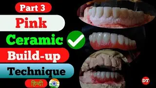 Pink Ceramic Build up| Implant video| Implant Metal Ceramic| Pink Ceramic build-up Technique| Dental