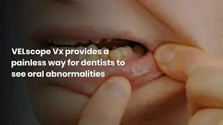 VELscope Vx provides a painless way for dentists to see oral abnormalities