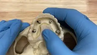 3D Printed Full Arch Implant Conversion