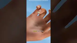 Trigger finger release surgery & fix (3D animation) #drone #theflash #space #automobile #rocketlab