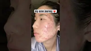 I dealt with painful, cystic acne for over a decade. I never thought I&rsquo;d get to this point🥹