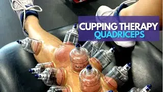 Cupping Therapy: Improving Range Of Motion to Quadriceps