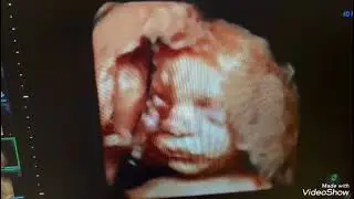 4 D ultrasound 