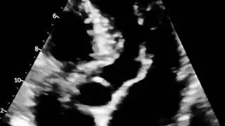 #female patient with systolic #murmur , any #conclusions ?