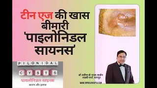 'कमर के नीचे का फोड़ा- पाइलोनाइडल सायनस'