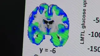 ISU study finds link between insulin resistance and memory loss