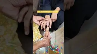 Realistic silicone finger prosthesis made in India. Custom, natural & life-like. #Prosthesis