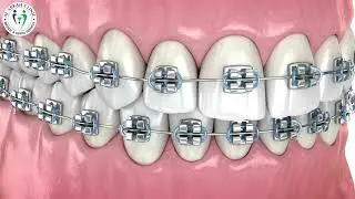 Orthodontic Braces | Dental Braces in Dubai