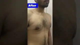 Scarless Gynecomastia Surgery Results Plastic Surgeon by Dr Arth Shah in India #shorts #ytshorts