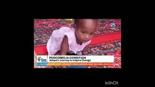 As I Grow NGO seeks support for child with Malformation of Limbs