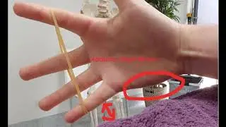 Finger collapse and pain in musicians