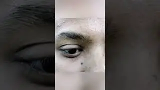 Artificial Eye Bangladesh