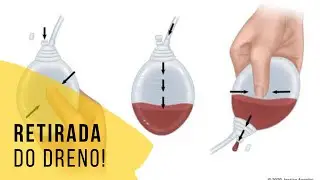 Como &eacute; a retirada do dreno?