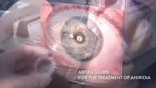 CUSTOMFLEX&reg; ARTIFICIALIRIS