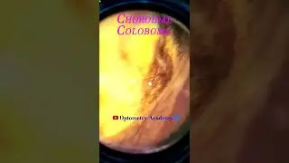 Choroidal Coloboma | Myopic degeneration | Fundus Photography | Short Video 72  #akleshkumar #viral