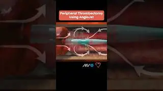 AngioJet Peripheral Thrombectomy System ✨🩸 #cardiologyeducation #cardiology