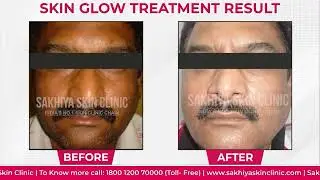 Best Pigmentation Treatment in India | Q-Switch Laser Review | Sakhiya Skin Clinic