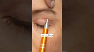 #oberlidstraffung #oderlid #lidstraffung #d&uuml;sseldorf #plastischechirurgie #blepharoplastysurgery