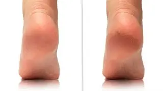 Remove cracked heels in Winters//Get smooth heels