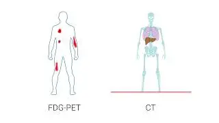 The FDG PET study