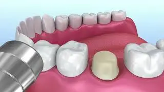 Dental Crowns with Glen Dental Center (Glenview IL Dentist)