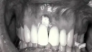 Oral Sex and HPV