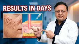 Best Results Acne Scar Combination Treatment | Pimple Scars | गड्ढे | Face Scars | Scar Treatment