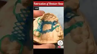 Cast Partial Denture Fabrication | Cast Partial Denture 💯 #shorts #dentist #viral 🔥