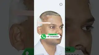 NW-5 Hair Transplant Result | 4200 Grafts S-FUE | Mumbai