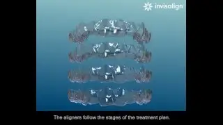 Dentist Invisalign Braces, Dental Concepts Whitchurch, Andover, Hampshire UK