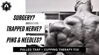 BODYBUILDER with TRAPPED NERVES recovers using CUPPING & SCRAPING!