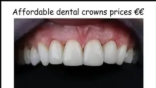 Affordable Dental Crowns Prices We mean it.!!
