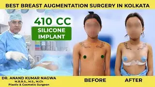 Best Breast Augmentation in Kolkata | 410cc Breast Implant  | Boobs Enlargement Dr. Anand Nagwani