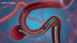 Interventional treatment of unruptured intracranial aneurysms