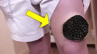 It Started as a Small Knee Bump&hellip; What Doctors Found Inside Was Terrifying!