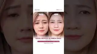 Cara mudah bebas dari kerutan dengan Botox di ElsheSkin Clinic