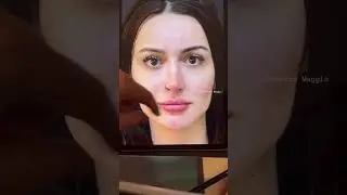 Caso transformador de harmonização facial pelo Dr Renato Maggio.