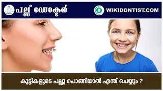 കുട്ടികളുടെ പല്ലു പൊങ്ങിയാൽ എന്ത് ചെയ്യും ?