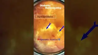 Hard Exudates | Diabetic retinopathy | Fundus Photography | Short Video 424