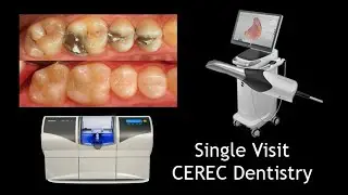 Single Visit CAD/CAM CEREC Dentistry Step by Step
