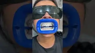 Watch the process of our in-office teeth whitening treatment ✨🤍