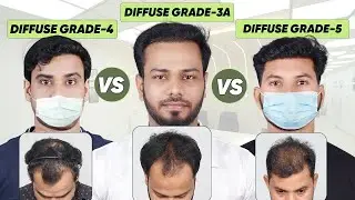 Best Hair Transplant in  Bangalore (HX-DFGE) | Best Results & Cost of Hair Transplant in  Bangalore.