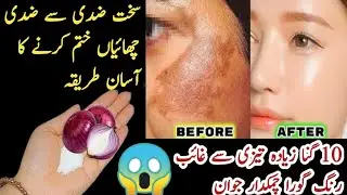 Amazing way to remove melasma using onion |Reduce melasma, pigmentation, discoloration, black spots
