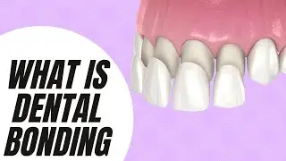 What is Dental Bonding? (3 Helpful Benefits You Should Know)