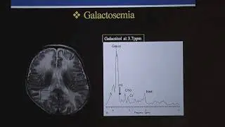 TMT: Pediatric White Matter Diseases - Part III by Dr Deepak Patkar