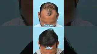 Stunning 9-Month Hair Transplant Transformation | 4500 Grafts with Boosted FUE Technique